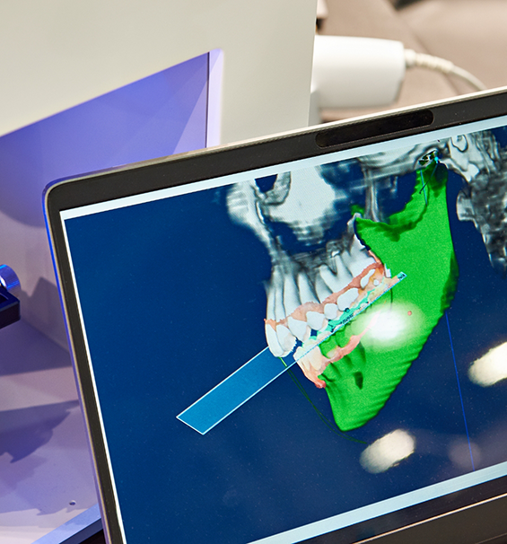 Computer screen showing a digital model of a patient's jawbone