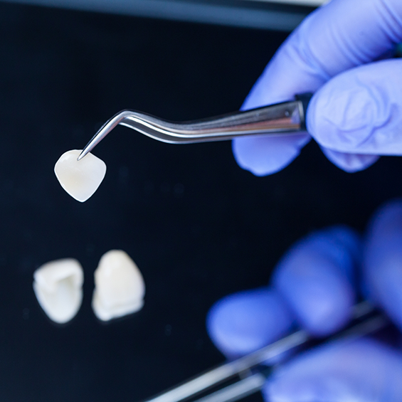 Dentist holding a veneer with tweezers