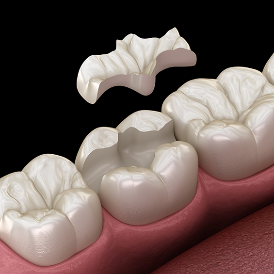 Illustration of a dental inlay being placed to restore a broken tooth