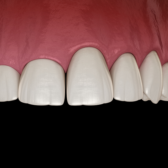 Illustration of an uneven gumline