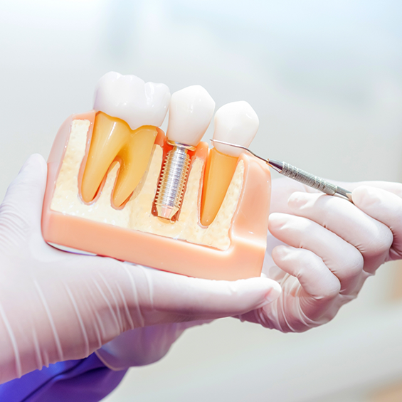 Model of a dental implant between two natural teeth