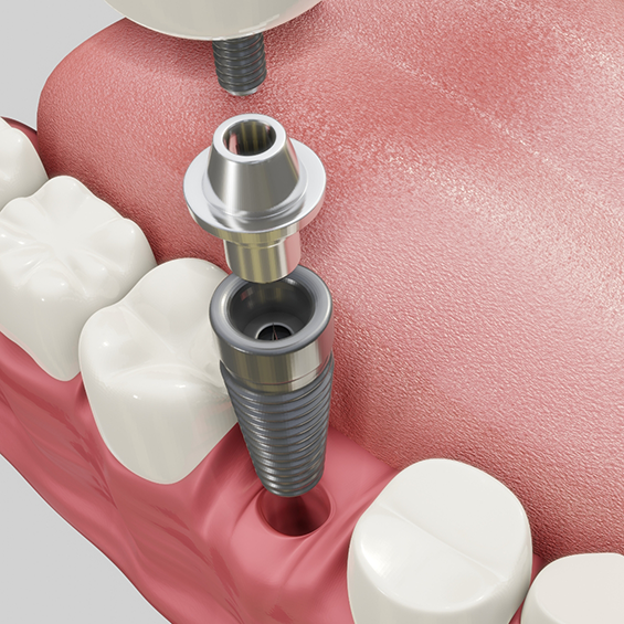 Illustration of a dental implant being placed in the lower jaw