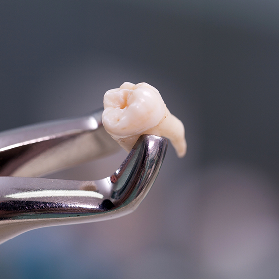 Forceps holding an extracted tooth