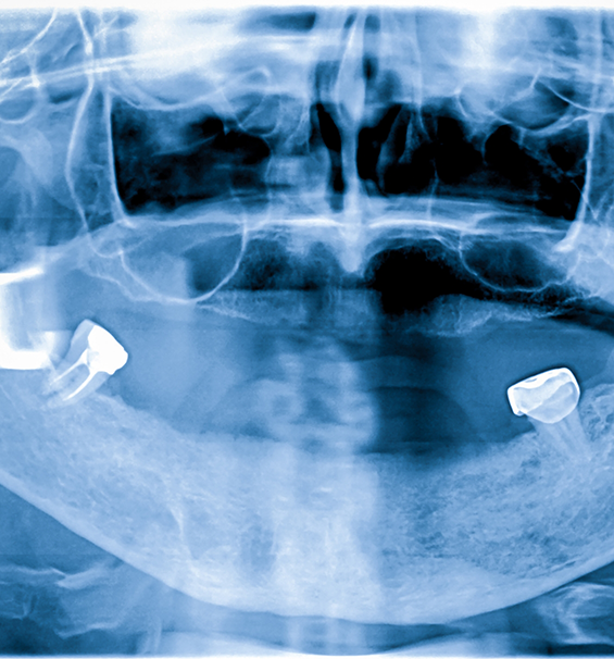 X-ray of a person with two dental implants replacing missing teeth