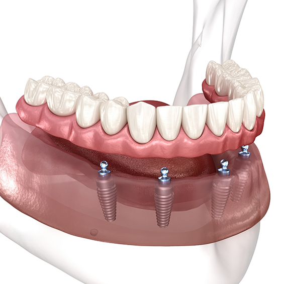 Illustrated implant denture