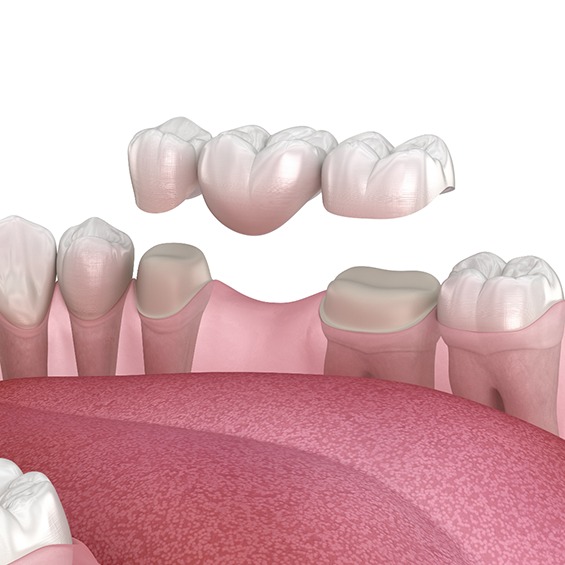 Illustrated dental bridge replacing a missing tooth