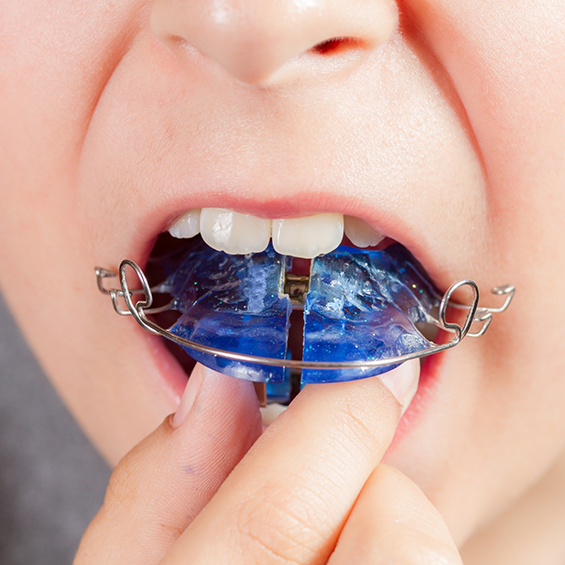 Person putting a retainer in their mouth