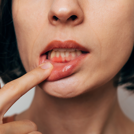 Close up of a woman pointing to her red gums