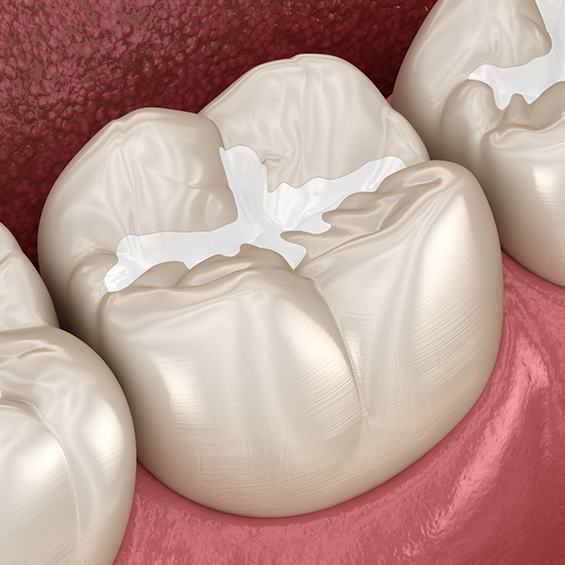 Illustration of a tooth with a white filling