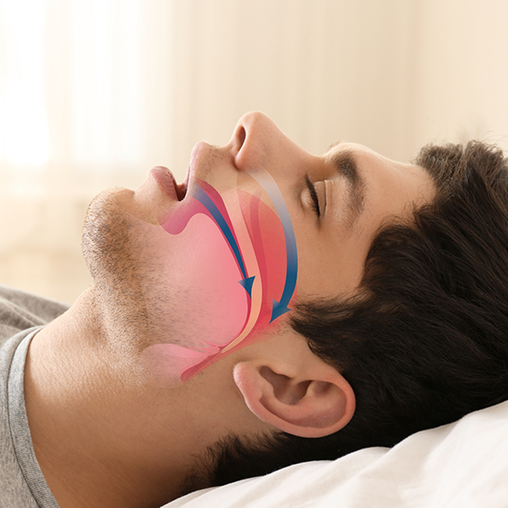 Man sleeping on his back with an illustration of his blocked airway