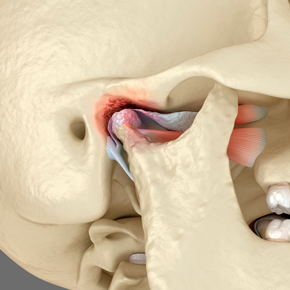 Illustrated skull with the jaw joint highlighted red