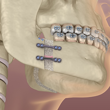 Illustration of the jaws being slowly readjusted